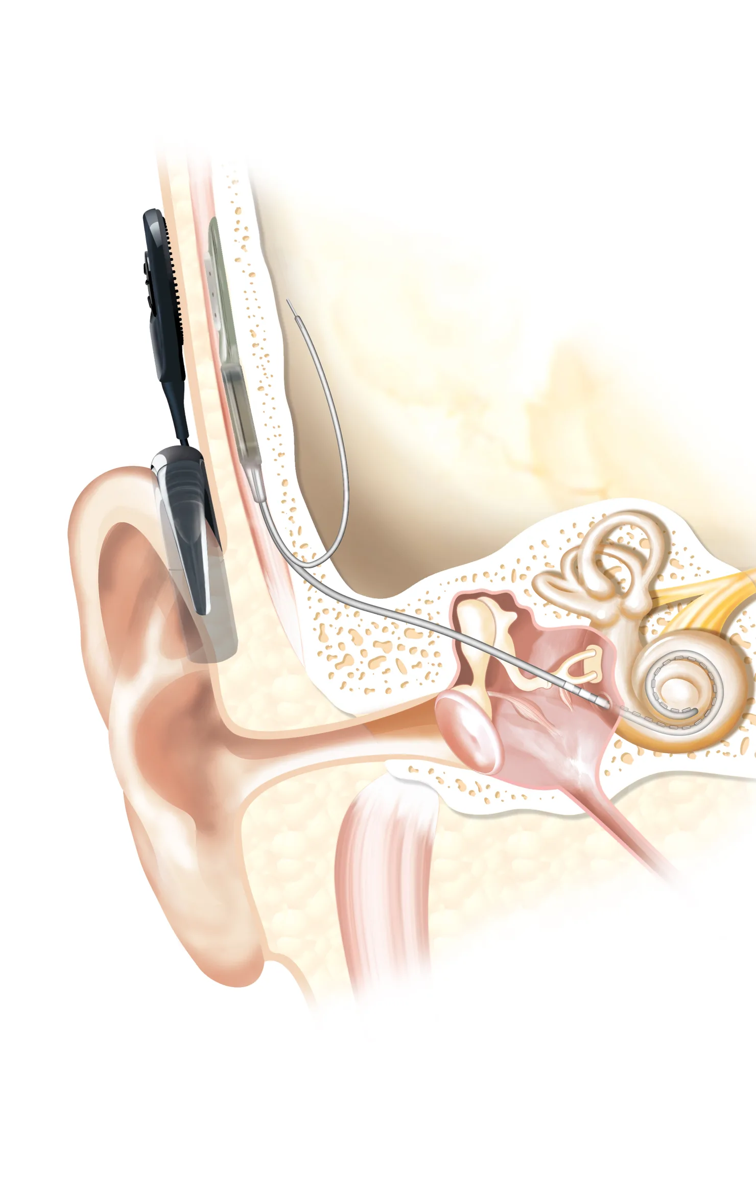 Medizinische Illustration: Audioprozessor hinter dem Ohr, Sendespule, Implantat unter der Haut und Elektrodenträger, der in die Hörschnecke führt